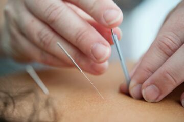 Acupuncture